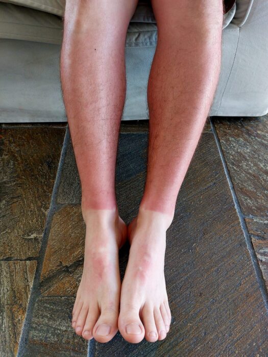 ciprus veszélyei - leégés, magas UV sugárzás